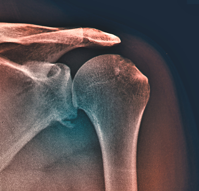 Bankart lesion, X ray Coloured X ray showing a small bone fragment of the left shoulder of a 23 years old handball player with previous injuries to this shoulder. This fragment is displaced from the lower edge of the glenoid cavity suggestive of a Bankart lesion. Bankart lesions are injuries of the anterior  inferior  glenoid labrum of the shoulder and can occur due to a shoulder dislocation., by ZEPHYR SCIENCE PHOTO LIBRARY