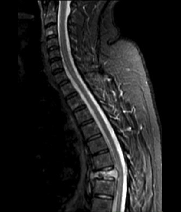 Spinal cancer, MRI scan Magnetic resonance imaging  MRI  scan of the cervio thoracic spine, of a 78 year old patient with multiple myeloma  bone cancer . The scan shows compression of the T7 thoracic vertebra, with receding of the posterior wall of the vertebral body and mass effect on the spinal cord., by ZEPHYR SCIENCE PHOTO LIBRARY