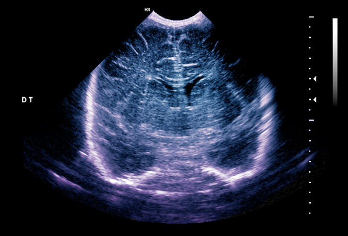 Normal premature newborn baby brain development, ultrasound Ultrasound showing the normal brain development of a newborn baby at less than 2 months old, born prematurely at 34 weeks. The scan shows the normal parenchyma, midline structures and ventricles of the brain., by ZEPHYR SCIENCE PHOTO LIBRARY