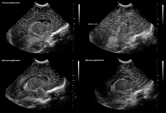 Premature baby normal brain development, ultrasound scans Ultrasound scans showing the normal brain development of a newborn baby at less than 2 months old, born prematurely at 34 weeks. The scan shows a parenchyma, normal right lateral ventricular structure, choroid plexuses with a thickness of about 5mm., by ZEPHYR SCIENCE PHOTO LIBRARY