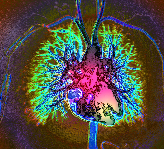 Heart and blood vessels, MRI angiogram Coloured frontal magnetic resonance angiogram  MRA  scan of a healthy heart and blood vessels. The heart is at centre, with its major blood vessels  including the aorta and vena cava . The kidneys are at bottom centre. The blood vessels of the neck and arms are at top centre and upper left and upper right. , by ZEPHYR SCIENCE PHOTO LIBRARY