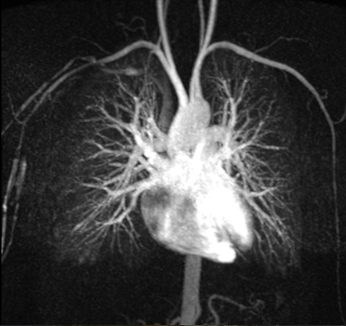 Healthy heart and blood vessels, MRI angiogram Frontal magnetic resonance angiogram  MRA  scan of a healthy heart and blood vessels. The heart is at centre, with its major blood vessels. The kidneys are at bottom centre. The blood vessels of the neck and arms are at top centre and upper left and upper right. MRA is a type of magnetic resonance imaging  MRI  technique that highlights blood vessels without the need for X rays or the injection of a radio opaque dye.  , by ZEPHYR SCIENCE PHOTO LIBRARY