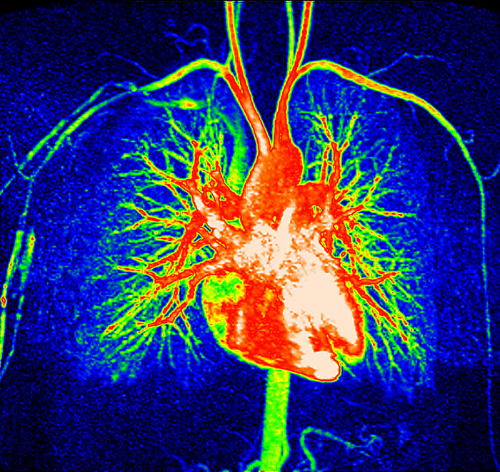 Healthy heart and blood vessels, MRI angiogram Coloured frontal magnetic resonance angiogram  MRA  scan of a healthy heart and blood vessels. The heart is at centre, with its major blood vessels. The kidneys are at bottom centre. The blood vessels of the neck and arms are at top centre and upper left and upper right. MRA is a type of magnetic resonance imaging  MRI  technique that highlights blood vessels without the need for X rays or the injection of a radio opaque dye.   , by ZEPHYR SCIENCE PHOTO LIBRARY