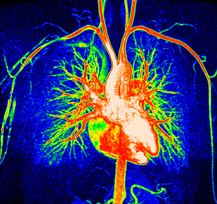 Healthy heart and blood vessels, MRI angiogram Coloured frontal magnetic resonance angiogram  MRA  scan of a healthy heart and blood vessels. The heart is at centre, with its major blood vessels. The kidneys are at bottom centre. The blood vessels of the neck and arms are at top centre and upper left and upper right. MRA is a type of magnetic resonance imaging  MRI  technique that highlights blood vessels without the need for X rays or the injection of a radio opaque dye.   , by ZEPHYR SCIENCE PHOTO LIBRARY