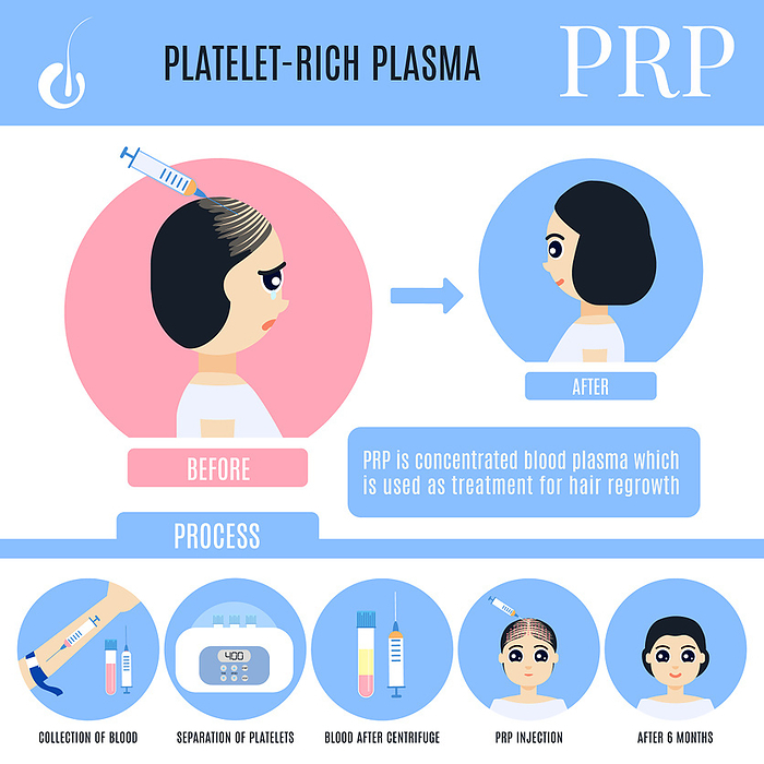 PRP hair loss treatment in women, illustration Platelet rich plasma  PRP  hair loss treatment in women, illustration., by ART4STOCK SCIENCE PHOTO LIBRARY