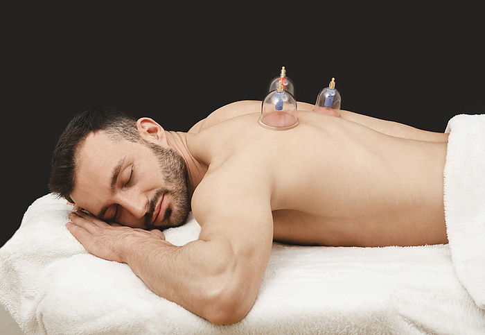 Cupping therapy Cupping therapy., by PEAKSTOCK   SCIENCE PHOTO LIBRARY
