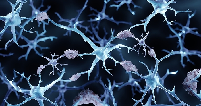 Alzheimer s disease, illustration Illustration of amyloid plaques in Alzheimer s disease., by ARTUR PLAWGO   SCIENCE PHOTO LIBRARY