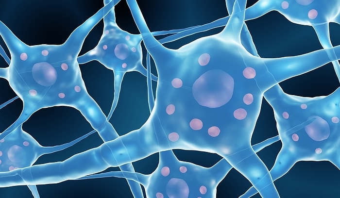 Parkinson s disease neurons, illustration Illustration of Lewy bodies in neurons. Lewy Bodies are accumulations of proteins that develop inside nerve cells in Parkinson s disease., by ARTUR PLAWGO   SCIENCE PHOTO LIBRARY