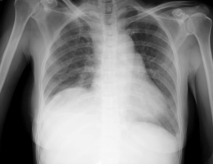Miliary nodules, X ray X ray of a patient with miliary nodules. Miliary refers to innumerable small 1 4 millimetre pulmonary nodules throughout the lungs. On a chest X ray, the differential diagnosis of miliary pattern includes miliary tuberculosis, histoplasmosis, sarcoidosis, pneumonia, bronchoalveolar carcinoma, pulmonary siderosis, and hematogenous metastases from thyroid, kidney, and sarcoma primary cancers., by RAJAAISYA SCIENCE PHOTO LIBRARY