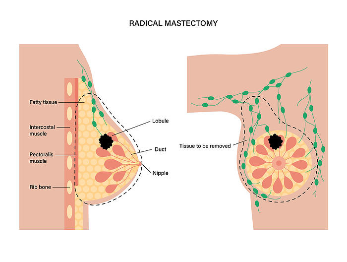 Female radical mastectomy, illustration Female radical mastectomy, illustration., by PIKOVIT   SCIENCE PHOTO LIBRARY