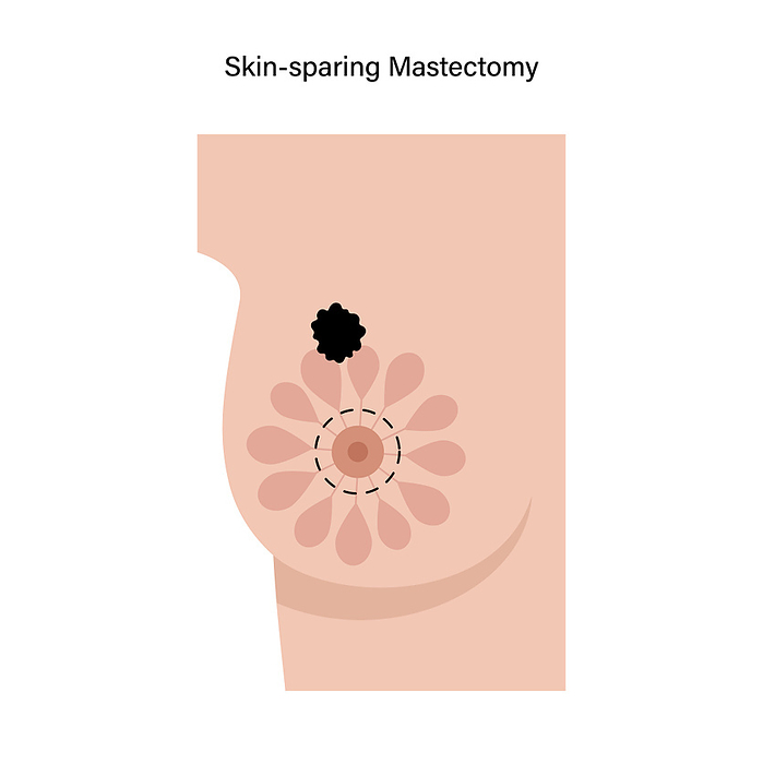 Female skin sparing mastectomy, illustration Female skin sparing mastectomy, illustration., by PIKOVIT   SCIENCE PHOTO LIBRARY