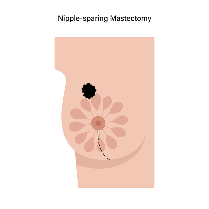 Female nipple sparing mastectomy, illustration Female nipple sparing mastectomy, illustration., by PIKOVIT   SCIENCE PHOTO LIBRARY