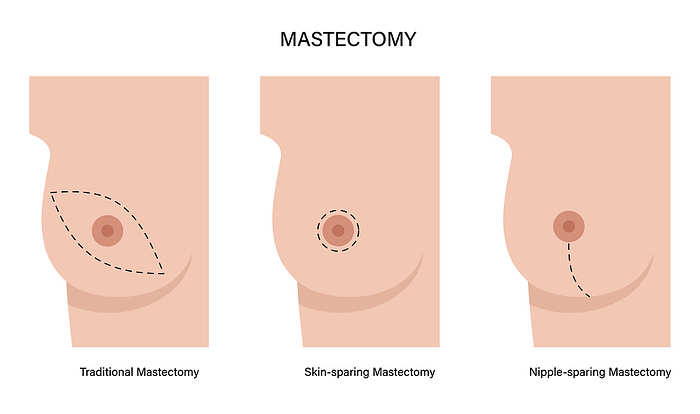 Types of female mastectomy, illustration Types of female mastectomy, illustration., by PIKOVIT   SCIENCE PHOTO LIBRARY