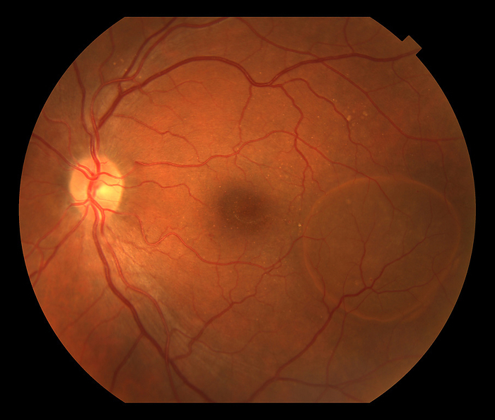 Eye damage due to diabetes, fundoscopy Fundoscopy image of the left eye of a male patient with diabetes that has lead to diabetic retinopathy. The retina is the light sensitive layer at the back of the eye. Diabetic retinopathy is damage to the blood vessels of the retina caused by the high blood sugar levels associated with diabetes. The damage has also lead to retinal pigment epithelial detachment  circular area at right , where fluid beneath the retinal pigment epithelium causes it to separate from its underlying membrane., by ALAN FROHLICHSTEIN SCIENCE PHOTO LIBRARY