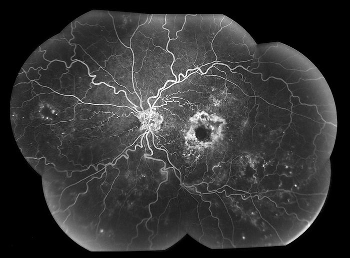 Central retinal vein occlusion, angiogram Composite fluorescein angiogram of the left eye of a patient with central retinal vein occlusion  CRVO . CRVO is a blockage of the main vein that drains the retina, the light sensitive layer at the back of the eye. The blockage causes blood and fluid to leak into the retina and the lack of oxygen can lead to damage or death of nerve cells. It causes blurred, or loss of, vision in the affected eye. Injections of drugs into the eye can stop the leakage from the vein. However, any underlying cause, such as high blood pressure or diabetes, needs to be treated to prevent a reoccurrence of the occlusion., by ALAN FROHLICHSTEIN SCIENCE PHOTO LIBRARY