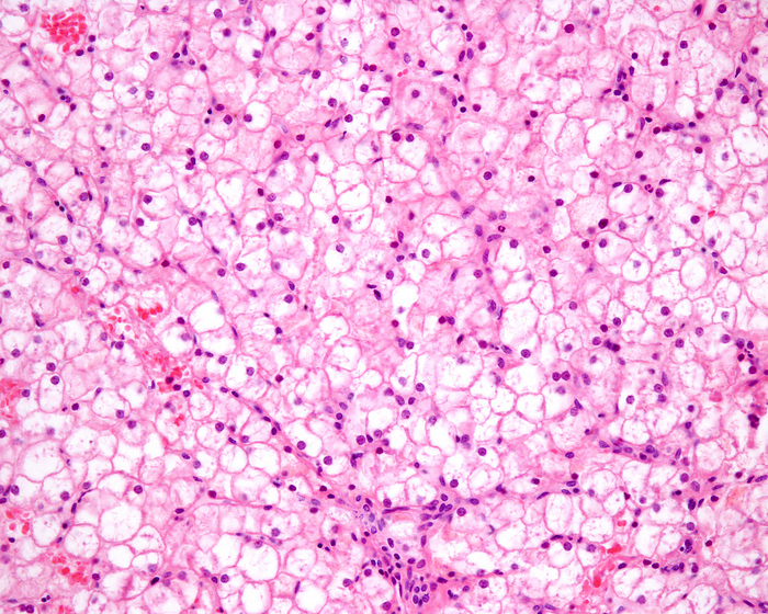 Glycogenosis, light micrograph Light micrograph of glycogenosis in a human liver. Hepatic glycogenosis is characterised by excessive glycogen accumulation in hepatocytes  liver cells  and represents a hepatic complication of diabetes that is more likely to occur in patients with longstanding poorly controlled type 1 diabetes. It can also be due to glycogen storage disease type I  GSD I , an inherited disease that results in the liver being unable to properly break down stored glycogen. After conventional tissue preparation  fixation by formaldehyde and staining with haematoxylin and eosin  the glycogen is usually removed from the hepatocytes, which appear diffusely swollen with a pale cytoplasm and accentuated cell membranes, frequently with displacement of the nuclei to the cell periphery., by JOSE CALVO   SCIENCE PHOTO LIBRARY