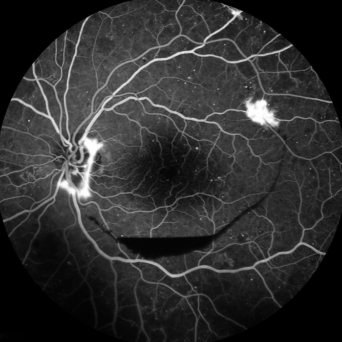 Retina damage from diabetes, angiogram Fluorescein angiogram of the retina of the left eye of a patient where severe damage to the retina has been caused by diabetes  diabetic retinopathy . Blood vessels  light grey  are seen emerging from the optic disc  left . The vessels have become blocked due to diabetes and have started to haemorrhage  bleed, bright white areas . This has caused a reduction in blood flow to other areas of the retina, leading to the proliferative growth of new capillaries. Diabetic retinopathy may lead to blindness if left untreated. Bleeding can be treated by laser photocoagulation, and blood sugar level maintenance can slow the disease s progress., by ALAN FROHLICHSTEIN SCIENCE PHOTO LIBRARY