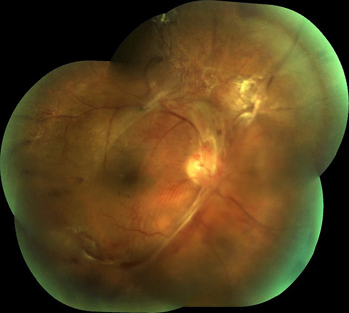 Retina damage from diabetes, fundoscopy Composite fundoscopy image of the retina of the right eye of a male patient where severe damage to the retina has been caused by diabetes  diabetic retinopathy . Blood vessels emerging from the optic disc have become blocked due to diabetes and have started to haemorrhage  bleed . This has caused a reduction in blood flow to other areas of the retina, leading to the proliferative growth of new capillaries. These new capillaries are pulling on the retina and have separated it from the back of the eye, a condition known as tractional retinal detachment. Diabetic retinopathy may lead to blindness if left untreated. Bleeding can be treated by laser photocoagulation, and blood sugar level maintenance can slow the disease s progress., by ALAN FROHLICHSTEIN SCIENCE PHOTO LIBRARY