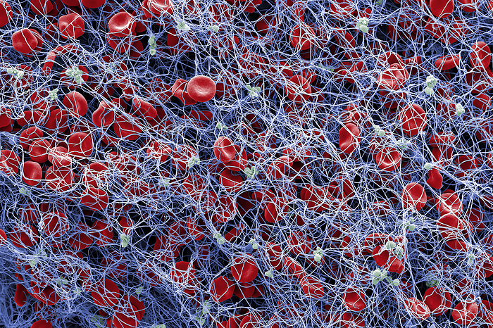 Red blood cells and platelets in blood clot, SEM Red blood cells  erythrocytes  and platelets  thrombocytes  in a fibrin mesh, coloured scanning electron micrograph  SEM . A blood clot is starting to form with many erythrocytes  red  becoming entangled in a fibrin mesh  blue . Erythrocytes transport oxygen from the lungs to the rest of the body and also remove carbon dioxide from the body by transporting it to the lungs where it is then exhaled. When a blood vessel becomes damaged, it will send a signal to the platelets  green  who respond by travelling to the damaged area and transforming into their active form as seen in this image. Fibrin is a protein formed from fibrinogen during the clotting of blood. The platelets clump together and, along with the polymerised fibrin, form a clot over the wound. Magnification: x1150 when printed at 10cm wide., by Anne Weston, EM STP, the Francis Crick Institute SCIENCE PHOTO LIBRARY