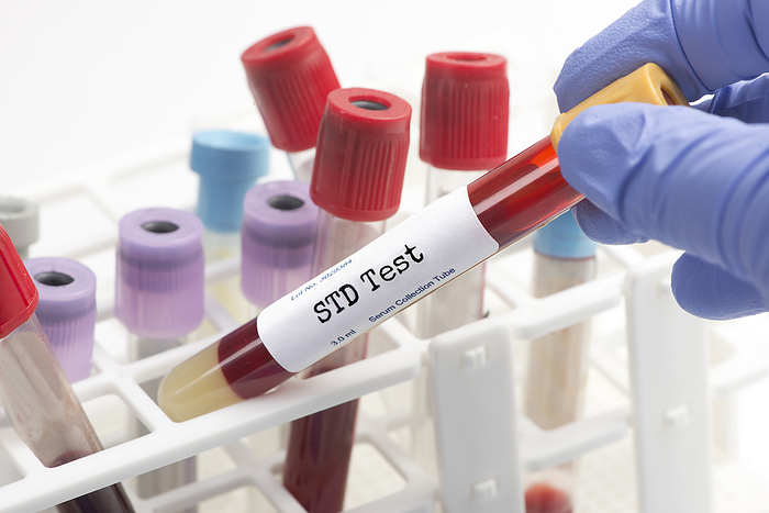 STD testing STD test blood analysis collection tube selected by technician., by SHERRY YATES YOUNG SCIENCE PHOTO LIBRARY