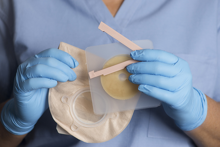 Ostomy bag, clip and adhesive wafer Nurse holding ostomy bag with adhesive wafer and bag clip., by SHERRY YATES YOUNG SCIENCE PHOTO LIBRARY