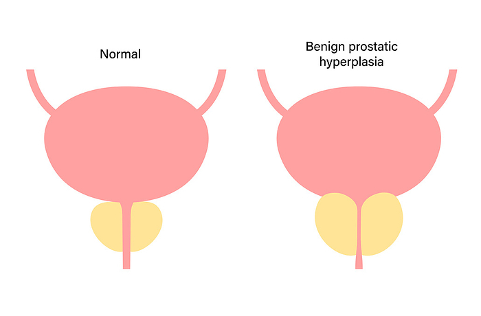Benign prostatic hyperplasia, illustration Benign prostatic hyperplasia  BPH , illustration., by PIKOVIT   SCIENCE PHOTO LIBRARY