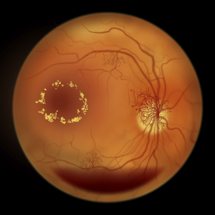 Retina damage from diabetes, illustration Proliferative diabetic retinopathy. Computer illustration showing preretinal haemorrhage as horizontal blood level, neovascularization in the disk and other sites, macula edema and hard exudates., by KATERYNA KON SCIENCE PHOTO LIBRARY