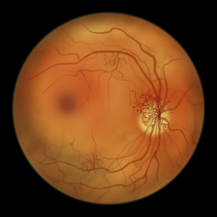 Retina damage from diabetes, illustration Proliferative diabetic retinopathy. Computer illustration showing neovascularization  formation of new vessels  in the optic disk and other sites., by KATERYNA KON SCIENCE PHOTO LIBRARY