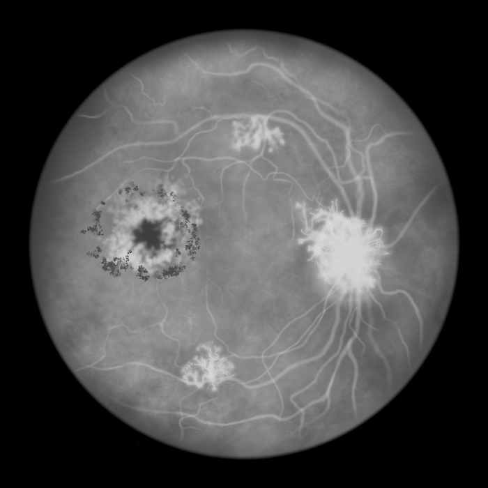 Retina damage from diabetes, illustration Proliferative diabetic retinopathy. Computer illustration showing neovascularization  formation of new vessels  in the optic disk and other sites, cystoid macula oedema, and hard exudates in fluorescein angiography., by KATERYNA KON SCIENCE PHOTO LIBRARY
