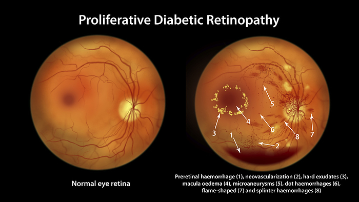 Retina damage from diabetes, illustration Proliferative diabetic retinopathy. Computer illustration showing a normal right eye and a right eye with preretinal haemorrhage, neovascularization, macula edema, hard exudates, cotton wool spots, microaneurysms, small haemorrhages, venous beading., by KATERYNA KON SCIENCE PHOTO LIBRARY