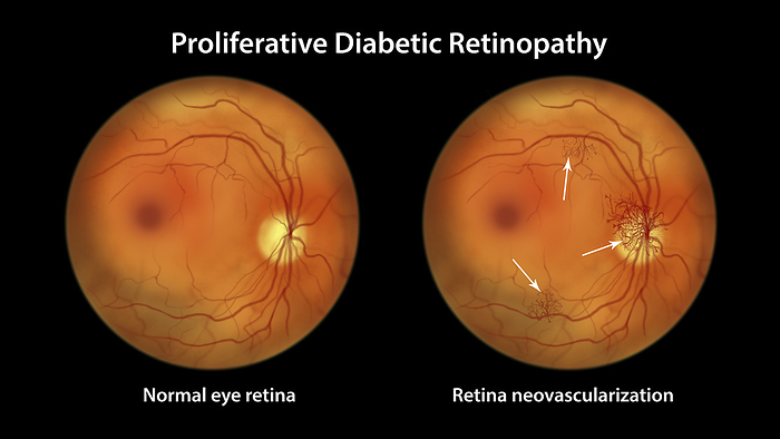 Retina damage from diabetes, illustration Proliferative diabetic retinopathy. Computer illustration showing a normal right eye and a right eye with neovascularization  formation of new vessels  in the optic disk and other sites., by KATERYNA KON SCIENCE PHOTO LIBRARY