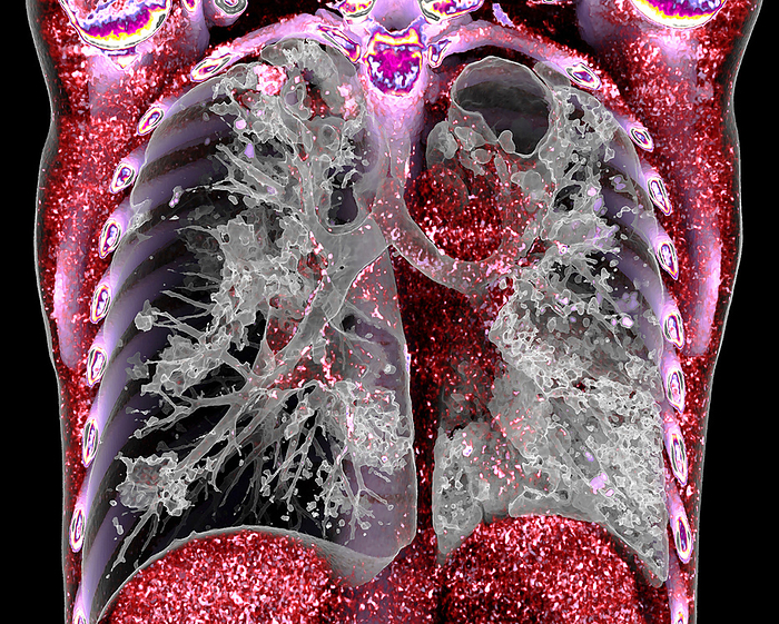 Tuberculosis, 3D CT scan 3D coloured computed tomography  CT  scan of the chest of a patient with pulmonary tuberculosis. Pulmonary tuberculosis is caused by the bacterium Mycobacterium tuberculosis, which is spread by coughing and sneezing. The bacteria create primary tubercles, nodular lesions of the lungs. Symptoms include fever, weight loss and the coughing up of blood. Treatment is with long term antibiotics., by VSEVOLOD ZVIRYK SCIENCE PHOTO LIBRARY