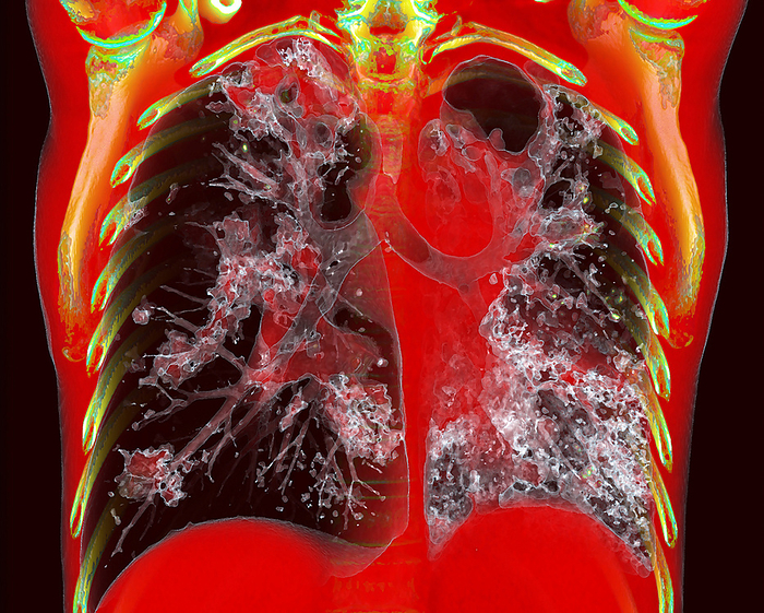 Tuberculosis, 3D CT scan 3D coloured computed tomography  CT  scan of the chest of a patient with pulmonary tuberculosis. Pulmonary tuberculosis is caused by the bacterium Mycobacterium tuberculosis, which is spread by coughing and sneezing. The bacteria create primary tubercles, nodular lesions of the lungs. Symptoms include fever, weight loss and the coughing up of blood. Treatment is with long term antibiotics., by VSEVOLOD ZVIRYK SCIENCE PHOTO LIBRARY