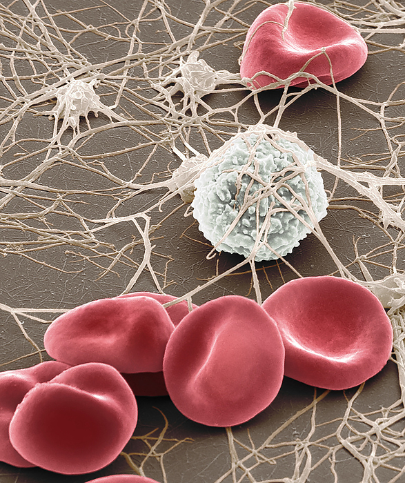 Blood cells, SEM Blood cells. Coloured scanning electron micrograph  SEM  of human red blood cells  erythrocytes , a single white blood cell  leucocyte  and platelets  pink  with fibrin strands. Red blood cells are biconcave, giving them a large surface area for gas exchange, and highly elastic, enabling them to pass through narrow capillary vessels. The cell s interior is packed with haemoglobin, a red iron containing pigment that has an oxygen carrying capacity. The main function of red blood cells is to distribute oxygen to body tissues and to carry waste carbon dioxide back to the lungs. White blood cells are part of the body s immune system and fight invading pathogens. Platelets are blood cell fragments that play an essential role in blood clotting and wound repair, and can also activate certain immune responses. Magnification: x2500 when printed at 10 centimetres wide., by STEVE GSCHMEISSNER SCIENCE PHOTO LIBRARY