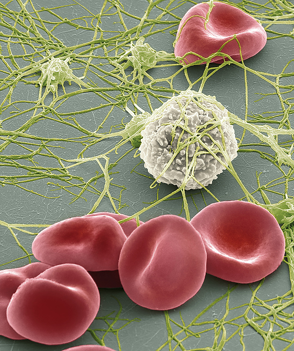 Blood cells, SEM Blood cells. Coloured scanning electron micrograph  SEM  of human red blood cells  erythrocytes , a single white blood cell  leucocyte  and platelets  green  with fibrin strands. Red blood cells are biconcave, giving them a large surface area for gas exchange, and highly elastic, enabling them to pass through narrow capillary vessels. The cell s interior is packed with haemoglobin, a red iron containing pigment that has an oxygen carrying capacity. The main function of red blood cells is to distribute oxygen to body tissues and to carry waste carbon dioxide back to the lungs. White blood cells are part of the body s immune system and fight invading pathogens. Platelets are blood cell fragments that play an essential role in blood clotting and wound repair, and can also activate certain immune responses. Magnification: x2500 when printed at 10 centimetres wide., by STEVE GSCHMEISSNER SCIENCE PHOTO LIBRARY