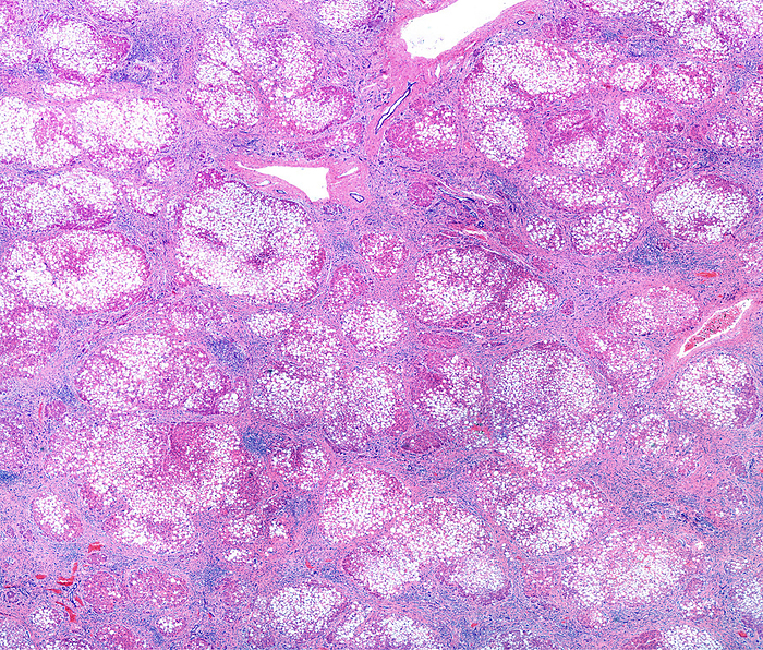 Cirrhosis and steatosis of the liver, light micrograph Micronodular cirrhosis in a human liver. Light micrograph showing regenerating nodules of hepatocytes  with an extensive fatty change , separated by fibrous septa with chronic inflammatory infiltrates. Cirrhosis of the liver is a result of severe damage to the liver. The hard scar tissue that replaces healthy liver tissue. Cirrhosis can lead to liver failure and liver cancer., by JOSE CALVO   SCIENCE PHOTO LIBRARY