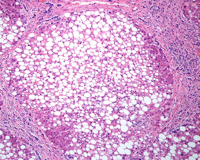 Cirrhosis and steatosis of the liver, light micrograph Micronodular cirrhosis in a human liver, light micrograph. Regenerating nodules of hepatocytes showing an extensive fatty change  steatosis , separated by fibrous septa with chronic inflammatory infiltrates., by JOSE CALVO   SCIENCE PHOTO LIBRARY