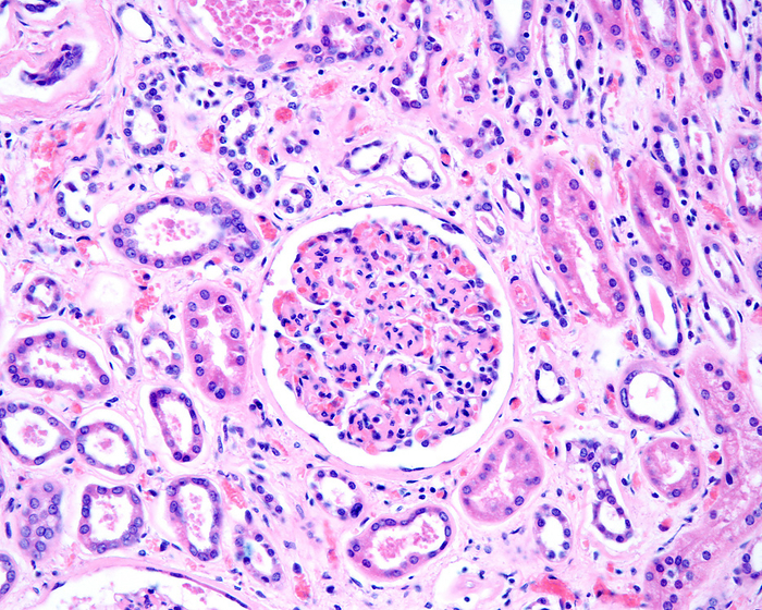 Diabetic nephropathy, light micrograph Light micrograph of a human kidney affected by an advanced diabetic nephropathy. Renal glomerulus showing diffuse mesangial expansion and thickening of the Bowman s capsule basement membrane., by JOSE CALVO   SCIENCE PHOTO LIBRARY