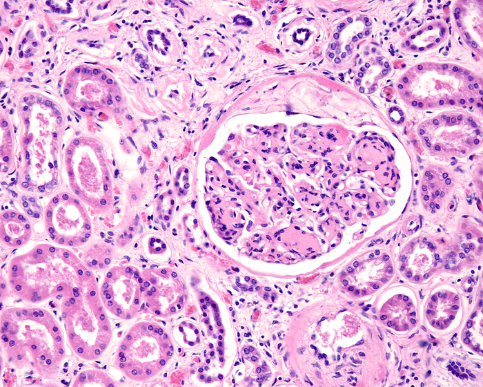 Diabetic nephropathy, light micrograph Light micrograph of a human kidney affected by an advanced diabetic nephropathy. Renal glomerulus showing diffuse mesangial expansion, Kimmelstiel  Wilson nodules, thickening of the Bowman s capsule basement membrane and capsular drop. At bottom is a blood vessel with hyalinosis. JOSE CALVO   SCIENCE PHOTO LIBRARY