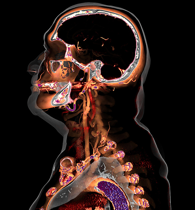 Atherosclerosis, 3D CT scan Coloured 3D computed tomography  CT  angiogram scan showing carotid arteries affected by atherosclerosis. Atherosclerosis is a condition in which an artery wall thickens as a result of accumulations  atheromas  of fatty materials such as cholesterol. Such narrowing of blood vessels raises blood pressure and is a risk factor for strokes., by VSEVOLOD ZVIRYK SCIENCE PHOTO LIBRARY