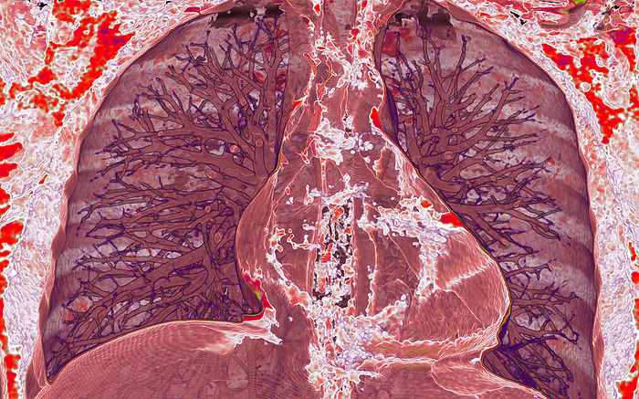 Healthy heart and lungs, 3D CT scan Coloured 3D computed tomography  CT  scan of a healthy heart and lungs. The heart  centre right  is a hollow sac of muscular tissue that pumps oxygenated blood around the body and deoxygenated blood to the lungs. The lungs are either side of the heart. They are the site of gaseous exchange, where carbon dioxide is removed from the blood and oxygen added., by VSEVOLOD ZVIRYK SCIENCE PHOTO LIBRARY