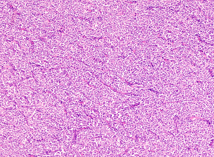 Clear cell sarcoma of kidney, light micrograph Clear cell sarcoma of kidney  CCSK , light micrograph. CCSK is a rare malignant mesenchymal neoplasm that is seen predominantly in pediatric patients. Although rare, it is the second most common pediatric renal tumour after Wilms tumour. It is characterized by aggressive behaviour, late recurrences, and a tendency to metastasize to bones  hence the previous name   bone metastasizing renal tumour of childhood . It shows two specific, mutually exclusive genetic alterations. About 85  of cases show internal tandem duplications in BCL 6 coreceptor  BCOR . Another 10  of cases have a translocation t 10 17  creating the fusion gene YWHAE NUTM2B E. The remaining 5  carry neither genetic alteration. This image of classic pattern of CCSK shows nests of small uniform polygonal to ovoid to spindle cells, separated by regularly spaced vascular channels., by WEBPATHOLOGY SCIENCE PHOTO LIBRARY