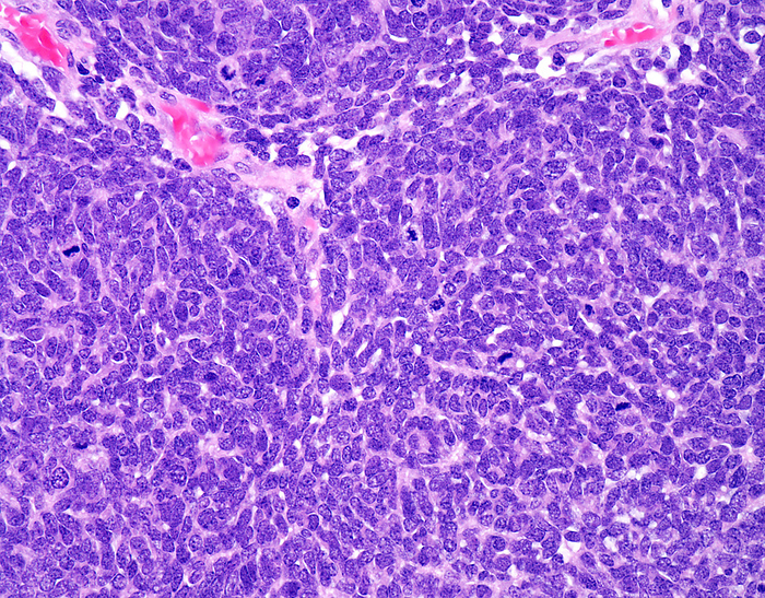 Nephroblastoma, light micrograph Nephroblastoma, light micrograph. Nephroblastoma, or Wilms tumour, is the fourth most common type of childhood cancer and the most common type of kidney cancer in children. The peak incidence is seen between 2 and 5 years of age. It is only rarely seen as a congenital neoplasm. They are usually solitary, large, and sharply demarcated tumours. About 7  are multicentric and 5  of cases are bilateral. In its classic microscopic appearance, Wilms tumour is triphasic and consists of variable proportions of blastema, stroma, and epithelial cells. One component may dominate over others in a given case, resulting in biphasic and monophasic variants. The blastemal component  shown here  of a Wilms tumour has the prototypical appearance of a small round blue cell tumour. It is highly cellular and consists of undifferentiated small round to oval cells with hyperchromatic nuclei and scant cytoplasm. The cells may be arranged in diffuse sheets, serpentine, or nodular patterns. Mitotic activity is generally brisk. Apoptosis and foci of necrosis may be seen within blastema., by WEBPATHOLOGY SCIENCE PHOTO LIBRARY