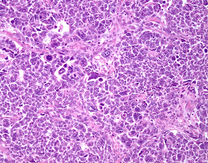 Nephroblastoma, light micrograph Nephroblastoma, light micrograph. Nephroblastoma, or Wilms tumour, is the fourth most common type of childhood cancer and the most common type of kidney cancer in children. The peak incidence is seen between 2 and 5 years of age. It is only rarely seen as a congenital neoplasm. They are usually solitary, large, and sharply demarcated tumours. About 7  are multicentric and 5  of cases are bilateral. Wilms tumours with anaplasia are said to have unfavourable histology since they show a lesser response to chemotherapy. Microscopically, they show 1  nuclei enlarged to at least 3 times the size of adjacent nuclei of the same cell type  2  marked hyperchromasia of the enlarged nuclei  and 3  multipolar mitotic figures. Unfavourable histology is seen in about 5  of Wilms tumours and is frequently associated with the presence of p53 mutations and resistance to chemotherapy., by WEBPATHOLOGY SCIENCE PHOTO LIBRARY