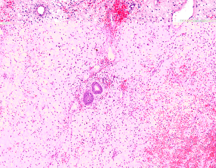 Nephroblastoma, light micrograph Nephroblastoma, light micrograph. Nephroblastoma, or Wilms tumour, is the fourth most common type of childhood cancer and the most common type of kidney cancer in children. The peak incidence is seen between 2 and 5 years of age. It is only rarely seen as a congenital neoplasm. They are usually solitary, large, and sharply demarcated tumours. About 7  are multicentric and 5  of cases are bilateral. Some of the current treatment protocols for Wilms tumour call for preoperative chemotherapy followed by resection. The post chemotherapy tumours are evaluated for response and subdivided into 3 risk categories : low risk, intermediate risk, and high risk. This image shows a few residual tubules surrounded by a zone of fibrosis and haemorrhage with scattered inflammatory cells., by WEBPATHOLOGY SCIENCE PHOTO LIBRARY