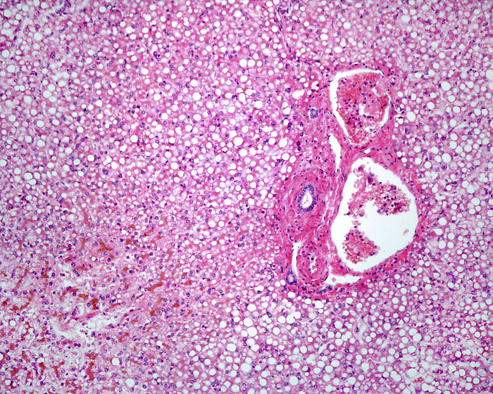 Human fatty liver, light micrograph Light micrograph of a human liver with steatosis  fatty liver . This condition leads to the accumulation of triglyceride fats  white spaces  in liver cells. The most common cause is heavy alcohol consumption, which disturbs normal fat metabolism. It can also be caused by toxins, diabetes and pregnancy. This micrograph shows a portal area surrounded by hepatocytes loaded with fat that look like an adipose tissue., by JOSE CALVO   SCIENCE PHOTO LIBRARY