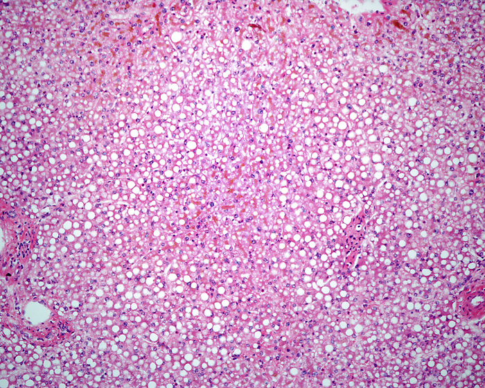 Human fatty liver, light micrograph Light micrograph of a human liver with steatosis  fatty liver . This condition leads to the accumulation of triglyceride fats  white spaces  in liver cells. The most common cause is heavy alcohol consumption, which disturbs normal fat metabolism. It can also be caused by toxins, diabetes and pregnancy. This micrograph shows hepatocytes heavily loaded with fat that look like an adipose tissue., by JOSE CALVO   SCIENCE PHOTO LIBRARY