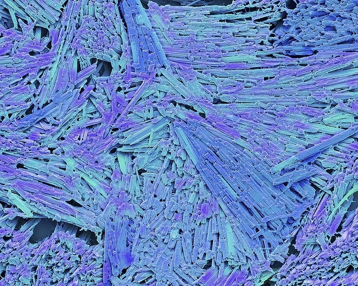 Uric acid crystals in gout, SEM False colour scanning electron micrograph of needle like crystals of sodium urate collected from a tophus  hard deposit of crystalline uric acid   its salts  from a patient with gout  gouty arthritis . Gout is a disease in which a defect in uric acid metabolism causes an excess of the acid   its salts  sodium urate  to accumulate in the bloodstream and the joints. These collect in the joint capsules causing an acute inflammation, with accompanying swelling, redness   pain. Gout is associated with  excessive living . Treatment involves the use of drugs   a warning against rich food   alcohol. Magnification: X 2000 at 10cm wide., by STEVE GSCHMEISSNER SCIENCE PHOTO LIBRARY