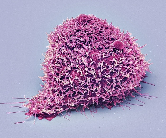 Kidney cancer cell, SEM Kidney cancer cell. Coloured scanning electron micrograph  SEM  of a Kidney carcinoma cell. Cancer cells divide rapidly in a chaotic manner and may clump to form tumours. They often invade and destroy surrounding tissues. Renal cell carcinoma  RCC  is the most common of the tumours of the kidney in adults, accounting for 86  of neoplasms arising from the kidney. Renal cancers account for approximately 2 3  of all malignancies, with the highest incidence in Western countries. Surgery is the main treatment for kidney cancer that hasn t spread outside the kidney. Magnification: x 6000 when printed at 10cm wide, by STEVE GSCHMEISSNER SCIENCE PHOTO LIBRARY