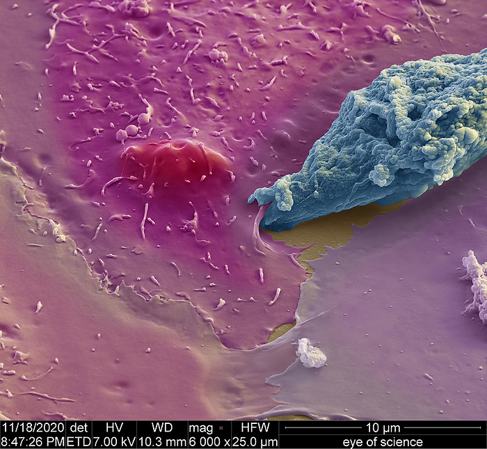 Entamoeba protozoan, SEM Coloured scanning electron micrograph  SEM  of an Entamoeba gingivalis amoeba  blueish  entering a gingival cell  red  in vitro. This amoeboid protozoan colonizes healthy oral mucosa. Colonisation can be asymptomatic, and is not considered pathogenic. However, E. gingivalis is able to invade lacerated oral mucosa, where it ingests fragments of live cells  trogocytosis , suggesting pathogenic potential. Magnification: x6000 when printed at 15 centimetres wide., by EYE OF SCIENCE SCIENCE PHOTO LIBRARY